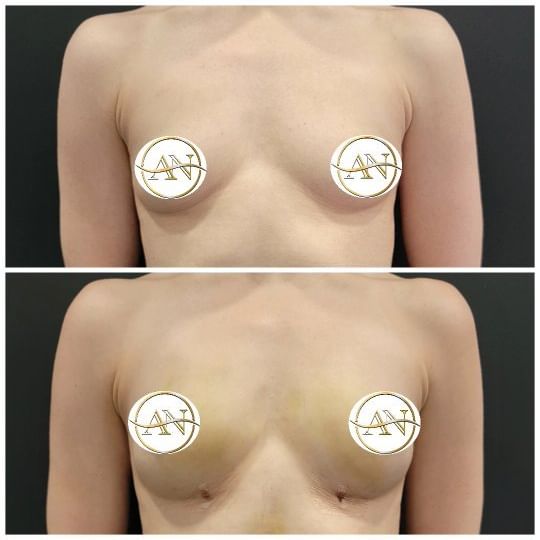 Three days after breast augmentation by fat transfer. No implants used in this case!!