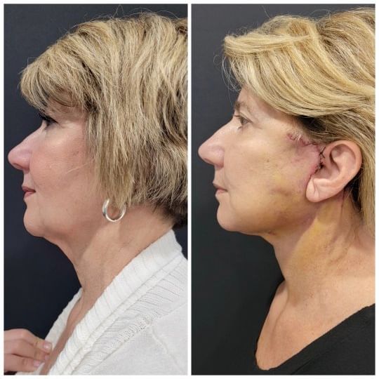 One week after facelift, necklift, fat grafting to the face!