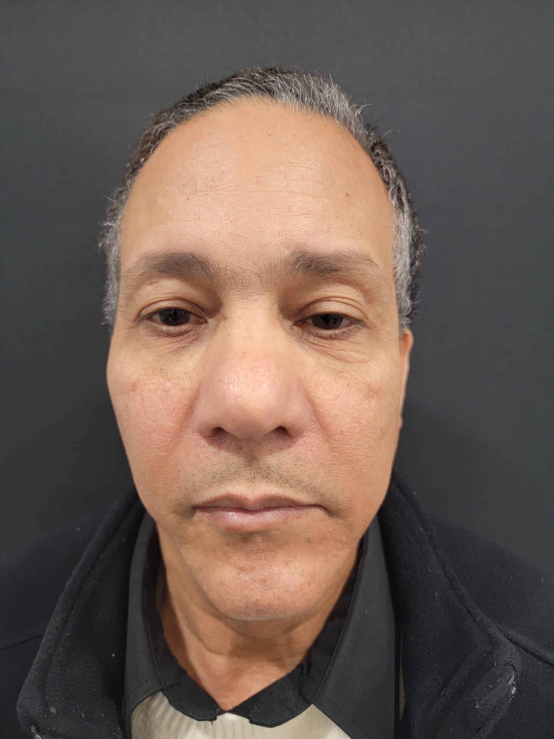 Case--8608-Rhinoplasty | Before Rhinoplasty