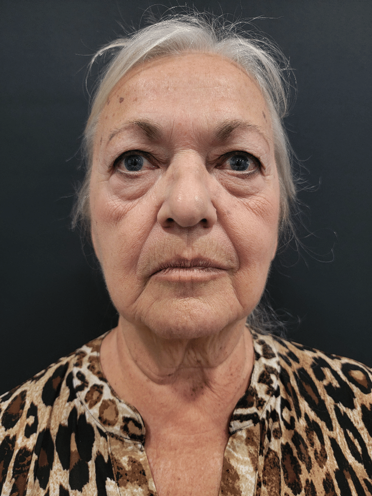 Case--4194-Facelift | Before Facelift