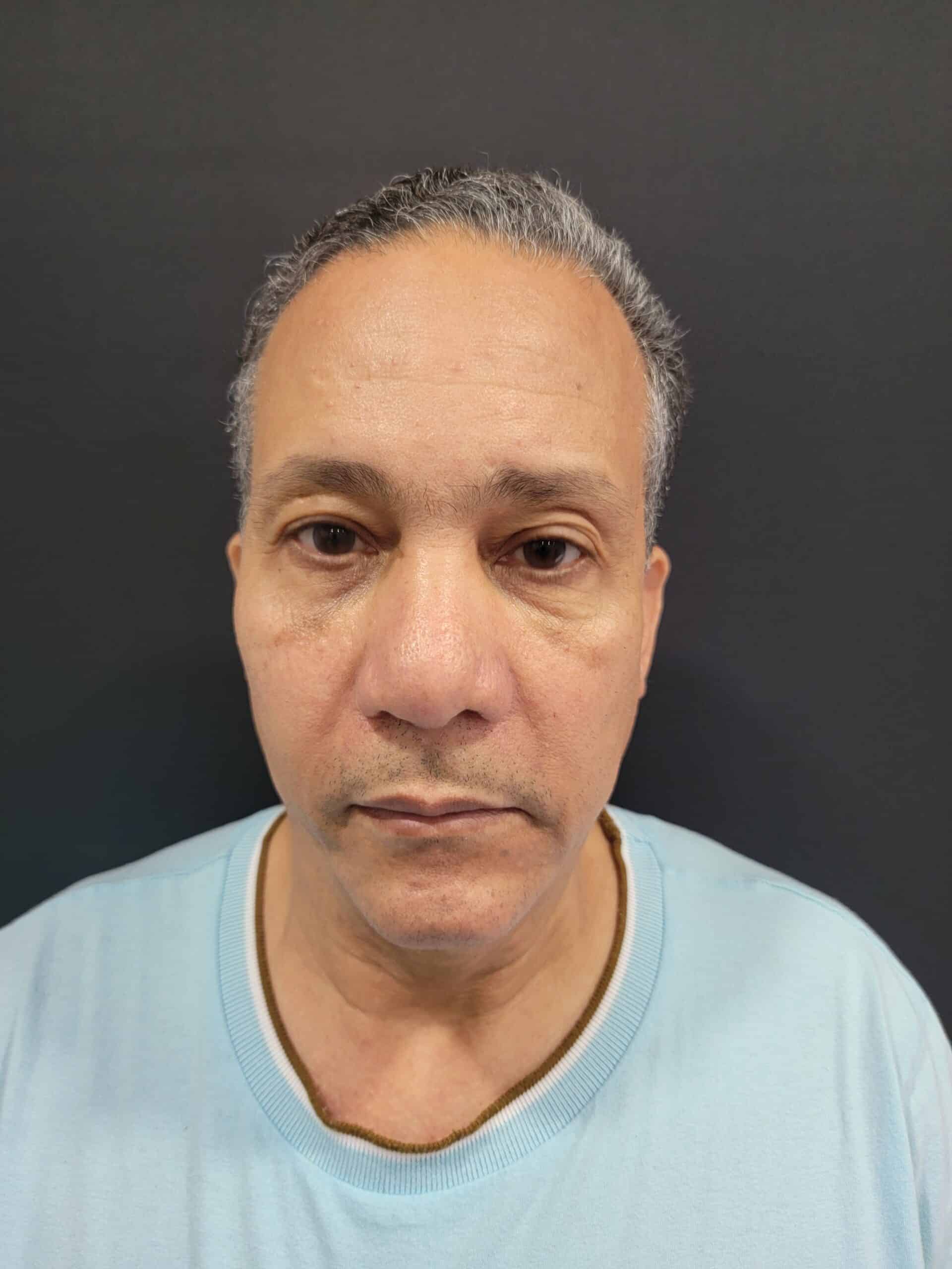 Case--8608-Rhinoplasty | After Rhinoplasty