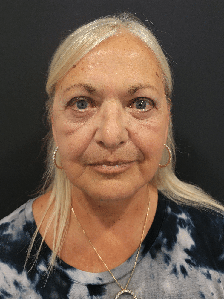 Case--4194-Facelift | After Facelift